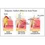 Sulfur Soap - Medical Grade OTC Dermatologists Approved 40 yrs for Acne