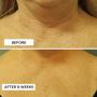 Perricone MD Cold Plasma Plus+ Neck & Chest Broad Spectrum SPF 25 1 Oz