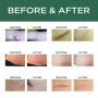 Scar Removal Cream Advanced Treatment for Old & New Scars from Cuts Stretch Marks, C-Sections & Surgeries With Natural Herbal Extracts Formula