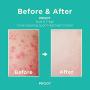 Butt & Thigh Acne Clearing Spot Treatment Cream. Clears Acne, Pimples, Ingrown Hairs, Blackheads, Zits, Razor Bumps and Dark Spots for the Buttocks and Thigh Area. Prevents Future Breakouts.