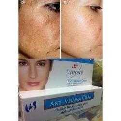 Vincere Anti Melasma Cream Reduces Dark & Brown Spots, Age Spots, Sun Spots, Pigmentation, Freckles : 1 Piece