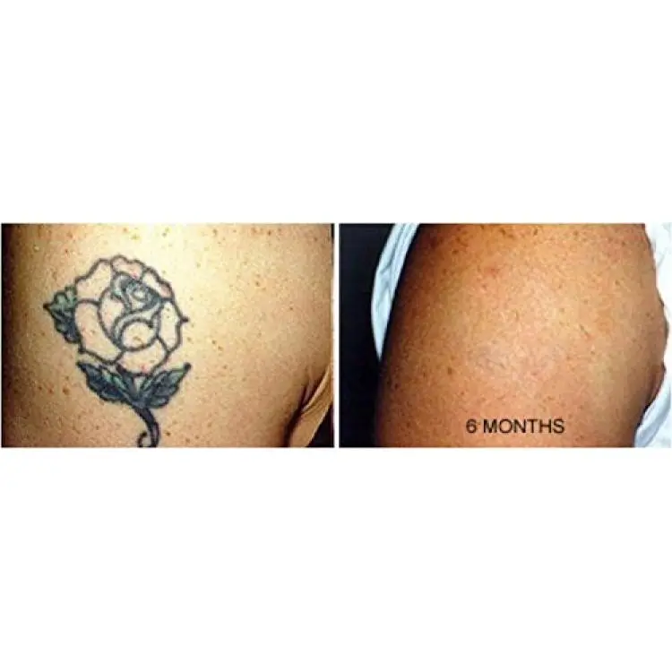 Amazon.com: Tattoo Removal Cream 2 month spartan perform