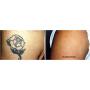 Tattoo Removal Cream Natural Fading system wrecking balm 2 week spartan perform
