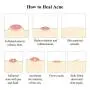 Acne Treatment Cream, BREYLEE Tea Tree Oil Acne Cream for Clearing Severe Acne, Breakout, Remove Pimple and Repair Skin (20ml,0.7oz) Acne Treatment Cream, BREYLEE Tea Tree Oil Acne Cream for Clearing Severe Acne, Breakout, Remove Pimple and Repair Skin (20ml,0.7oz)
