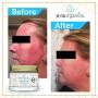 Era Organics Rosacea Redness Relief Cream - Soothe Anti Inflammatory Calming Face Moisturizer For Rosacea, Eczema, Acne Prone Skin- Dry, Sensitive Skin Care Milk Thistle, MSM, Avocado Oil & Chamomile