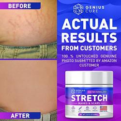 Stretch Marks & Scars Defense Cream Daily Moisturizer w Organic Shea Butter + Plant Oils + Vitamins to Prevent, Reduce and Fade Away Old or New Scars Best for Pregnancy 2oz
