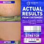 Stretch Marks & Scars Defense Cream Daily Moisturizer w Organic Shea Butter + Plant Oils + Vitamins to Prevent, Reduce and Fade Away Old or New Scars Best for Pregnancy 2oz
