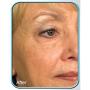 Biologic Stem Cell Wrinkle Therapy - (Set of 2)