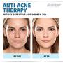 Anti-Aging Retinol Cream for Face with Hyaluronic Acid 3% - Wrinkle Cream for Face - Made in USA - Facial Moisturizer & Dark Spot Remover for Face - Retinol & Collagen Cream for Fine Lines