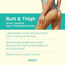 Butt & Thigh Acne Clearing Spot Treatment Cream. Clears Acne, Pimples, Ingrown Hairs, Blackheads, Zits, Razor Bumps and Dark Spots for the Buttocks and Thigh Area. Prevents Future Breakouts.